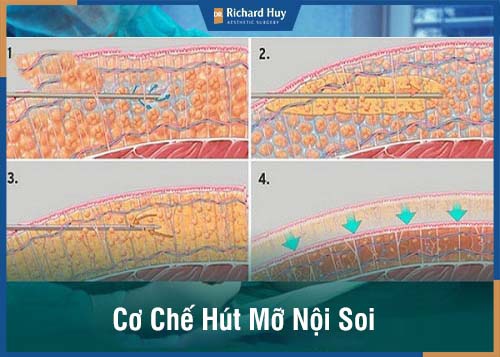 Mô phỏng cơ chế hút mỡ nội soi 