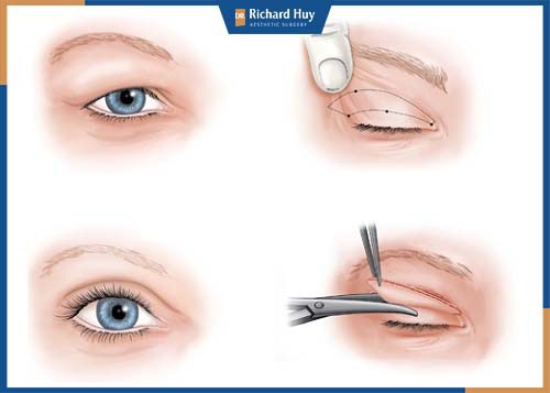 Mô phỏng kỹ thuật cắt mí mắt bồ câu 