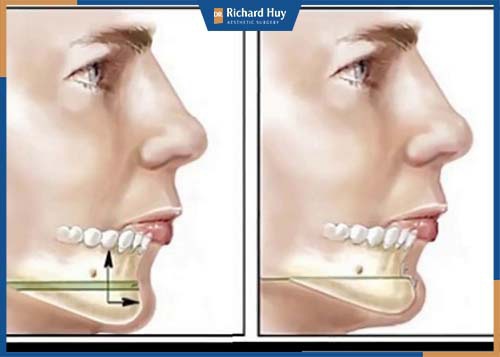 Mô phỏng kỹ thuật độn cằm tự thân