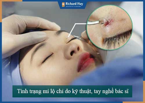 Nguy cơ bị lòi chỉ, tụt chỉ khi nhấn mí có cao hay không?