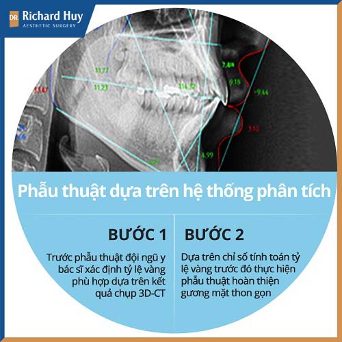 Mô phỏng phẫu thuật gọt hàm mặt vuông an toàn hiệu quả 