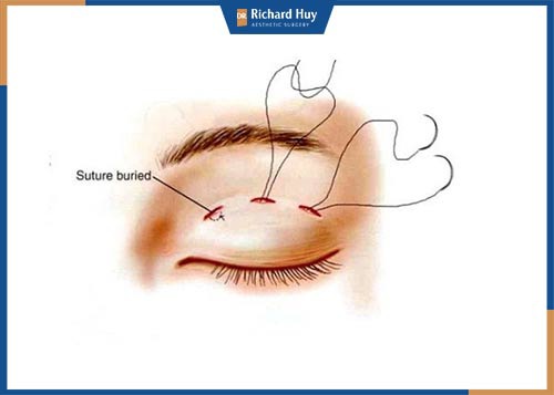 Nhấn mí mắt bằng phương pháp luồn chỉ