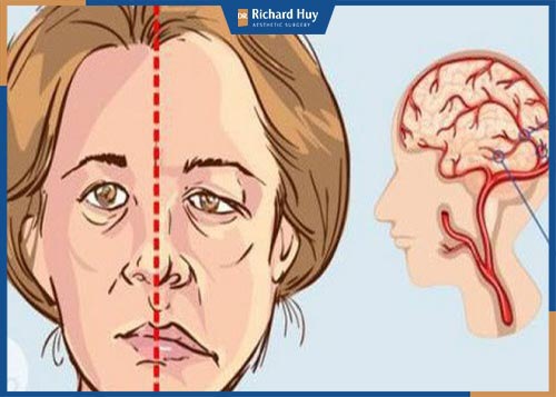 Mặt lệch bên phải chữa thế nào?