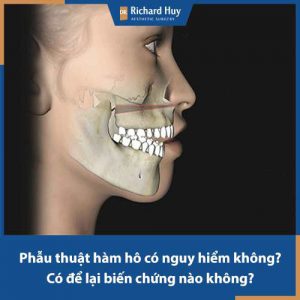 Phẫu thuật hàm hô có nguy hiểm không? Có nguy cơ xảy ra các biến chứng không?