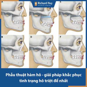 Phẫu thuật hàm hô giá bao nhiêu? Có nên chỉnh hình hàm hô giá rẻ hay không?