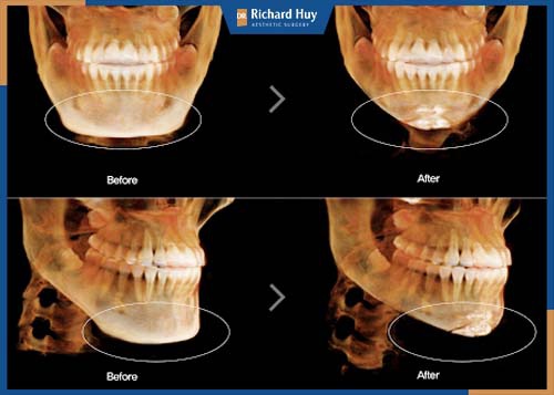 Điều chỉnh lại cấu trúc xương: Xương hàm, xương cằm, xương gò má, xương cành ngang sẽ được bác sĩ can thiệp. 