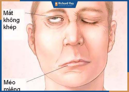 Biến chứng méo miệng do xâm lấn quá sâu ảnh hưởng tới dây thần kinh miệng 