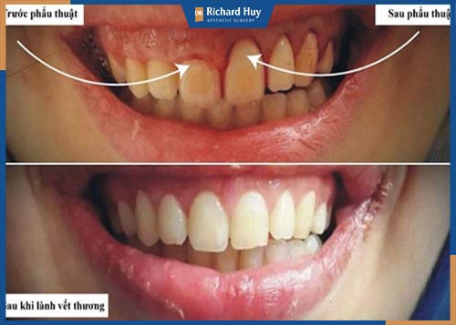 Tình trạng cười hở lợi được khắc phục triệt để