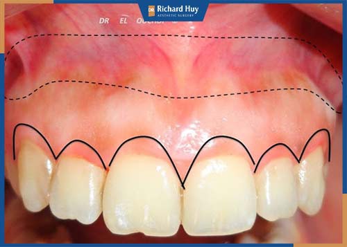 Phẫu thuật chữa cười hở lợi do xương