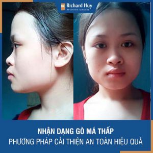 Nhận dạng gò má thấp - Phương pháp cải thiện gò má thấp an toàn, hiệu quả