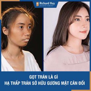 Giải đáp những thắc mắc về phương pháp gọt trán vạn người mê