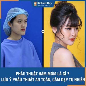 Phẫu thuật hàm móm là gì? Những lưu ý phẫu thuật hàm móm an toàn, đẹp tự nhiên