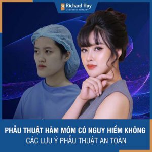 Phẫu thuật hàm móm có nguy hiểm không? Những lưu ý quan trọng  để phẫu thuật an toàn. 