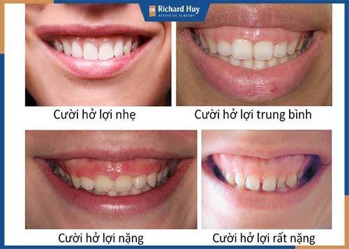 Các mức độ hở lợi thường gặp 