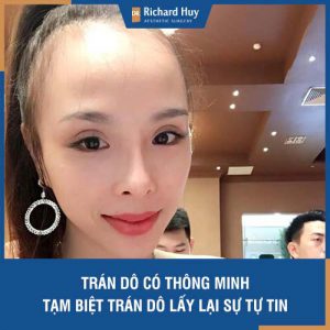 Giải mã chi tiết tướng trán dô - Người có trán dô phải làm gì để gương mặt cân đối.