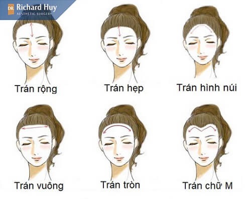 Các loại trán phổ biến hiện nay