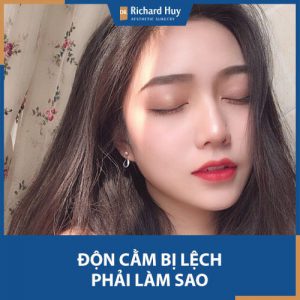 Độn cằm bị lệch có sửa lại được không? Dr. Richard Huy lưu ý cách khắc phục 