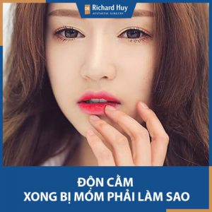 Độn cằm xong bị móm phải làm sao? Bác sĩ hướng dẫn cách khắc phục hiệu quả