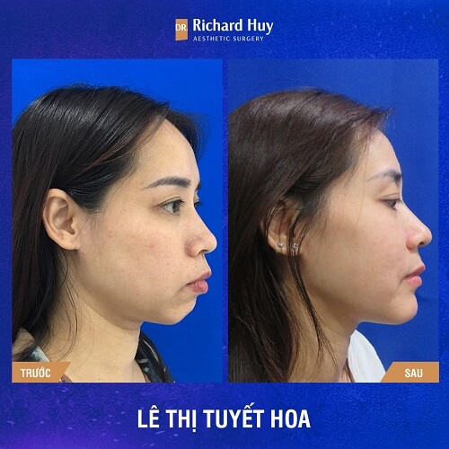 Hình ảnh trước sau quả phẫu thuật chỉnh hình hàm móm