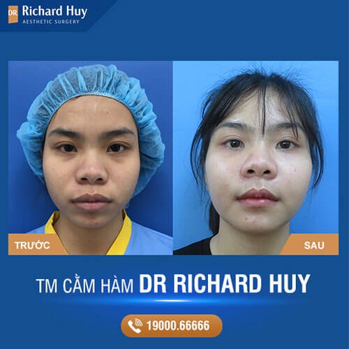 Kết qua khách hàng sau khi thực hiện độn cằm