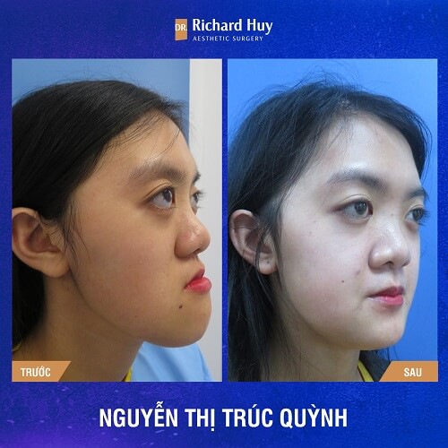 Khuân mặt bị biến dạng đã được cả thiện