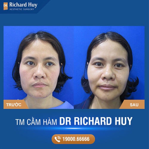 Kết quả đạt được sau quá trình thực hiện độn cằm