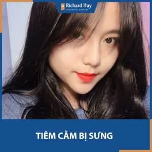 Tiêm cằm bị sưng do đâu? Làm sao để giảm sưng bớt đau?