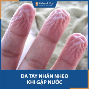 Da tay nhăn nheo khi gặp nước thì phải làm sao: Nguyên nhân và cách phòng tránh