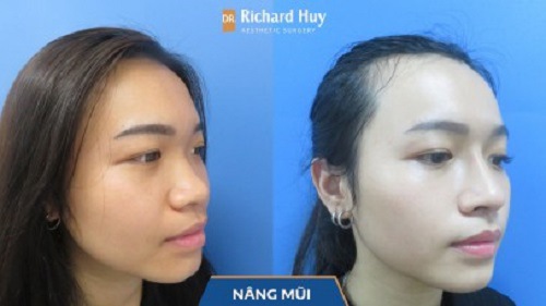 Kết quả đạt được khi thực hiện nâng mũi cùng Dr. Richard Huy 