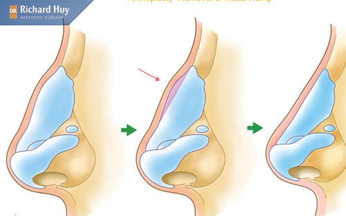 Kỹ thuật thực hiện thu nhỏ đầu mũi