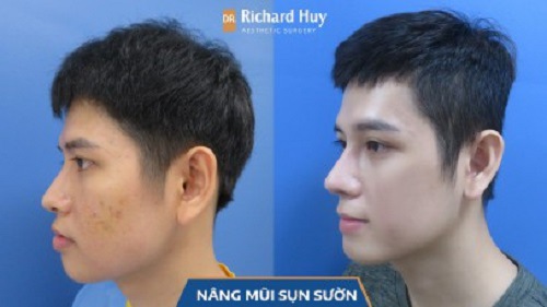 Thay đổi đang ngờ trước và sau khi nâng mũi tại Dr. Richard Huy 