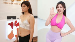 Giảm mỡ Lipo 360 Dr. Richard Huy - Eo thon, dáng chuẩn “tức thì”