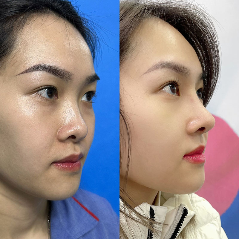 Rhinoplasty is a cosmetic procedure that enhances the shape of the nose, making it more balanced and in harmony with the face.