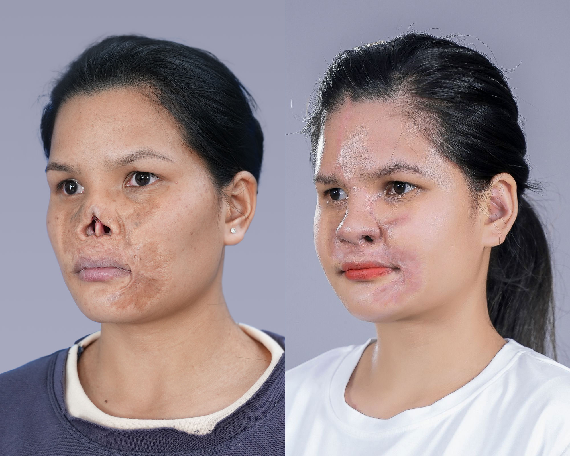 Lo Thi Le’s nose  before and after was restored by Dr. Richard Huy