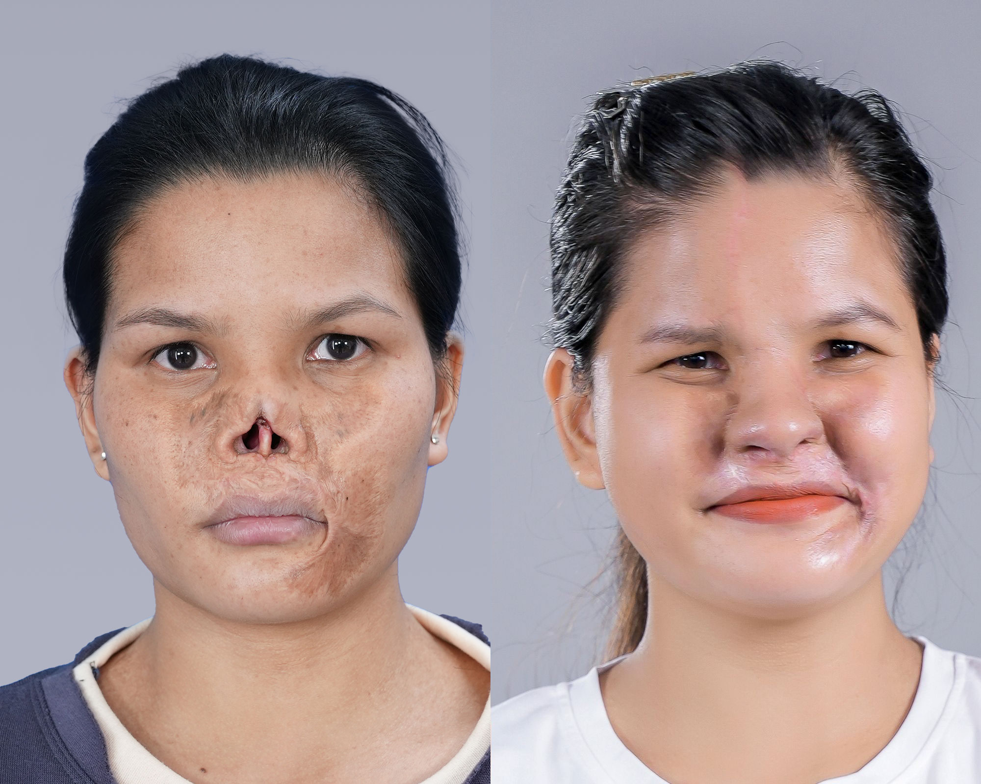 Lo Thi Le before and after nose reconstruction by Dr. Richard Huy