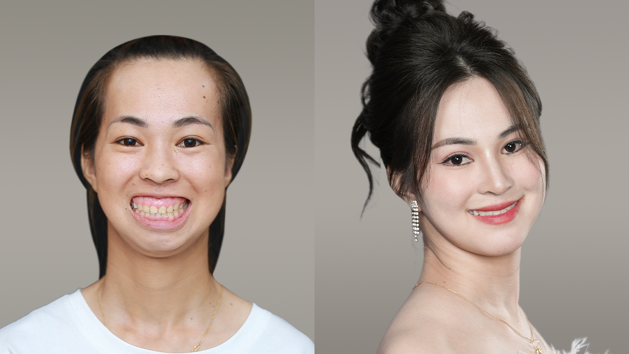 Customers undergoing double jaw correction combined with chin sliding at Dr. Richard Huy.