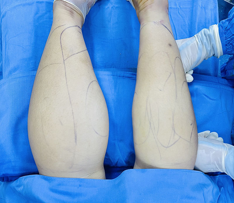 Slimmer Calves Immediately After Fat Reduction