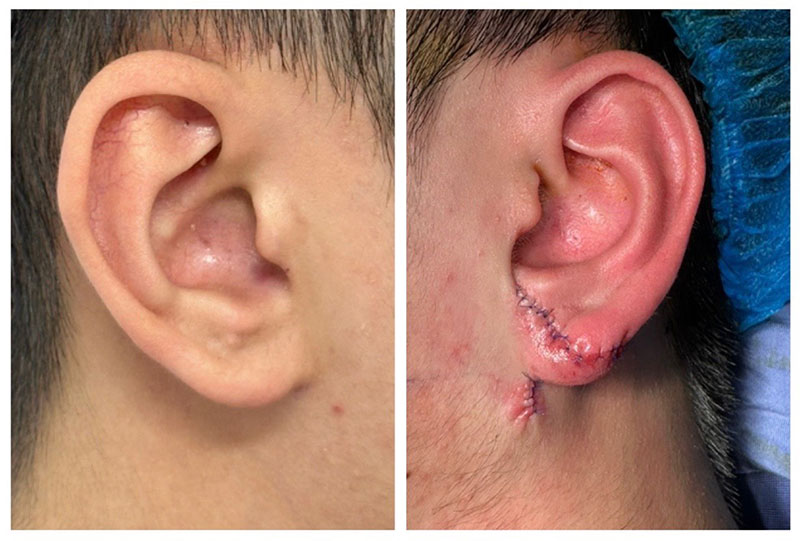 Second surgery: Complete ear shaping