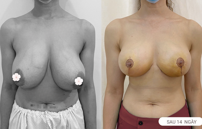 Breast lift surgery is safe when performed at a reputable facility.