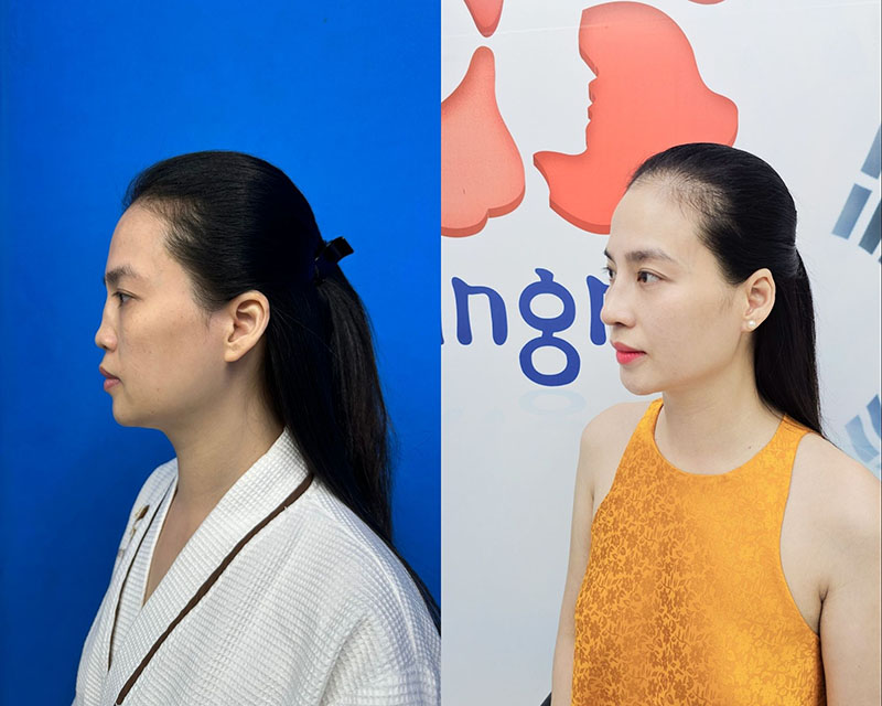 Thu Ha has a "divine" side profile after restoring her damaged nose.