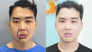 Cosmetic Solutions for the Face After Seventh Cranial Nerve Paralysis