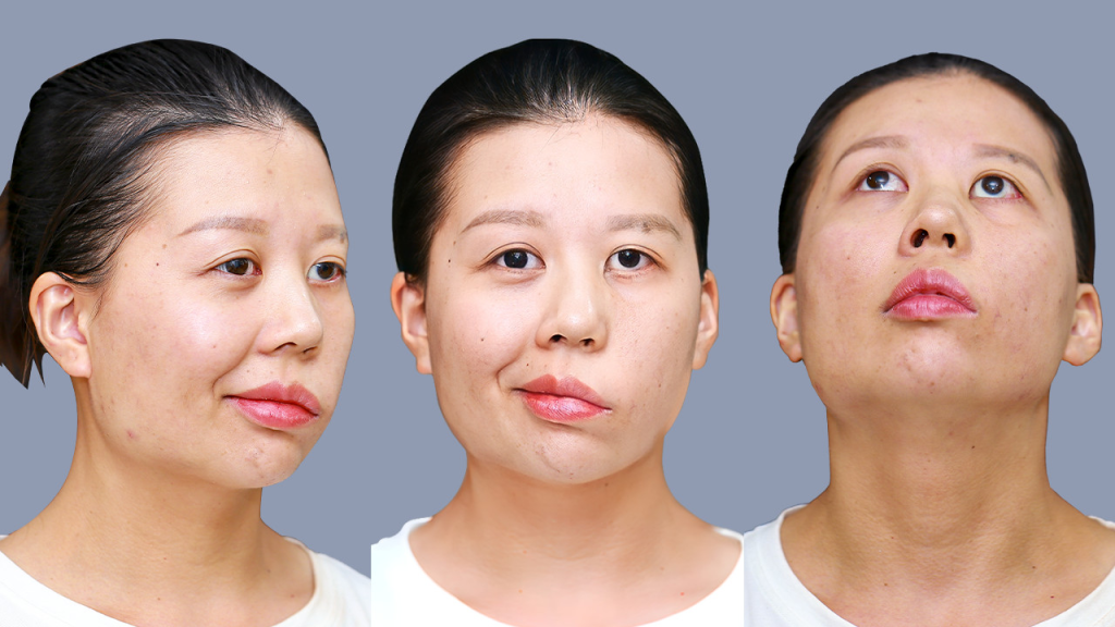 Le Huyen Trang suffered from facial paralysis since childhood, affecting her chewing function and facial expression.