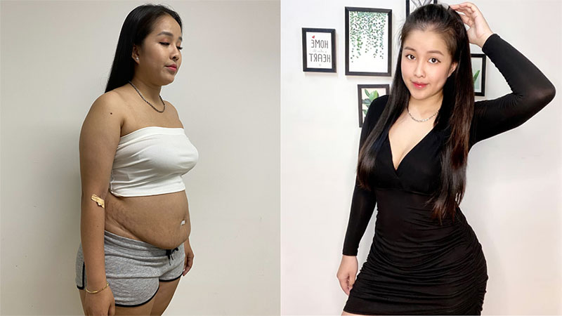 Reducing belly fat and shaping the abdomen is suitable for women after giving birth
