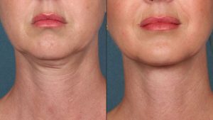 Dr. Richard Huy's Neck Lift - The Most Modern Solution to Eliminate Neck Wrinkles