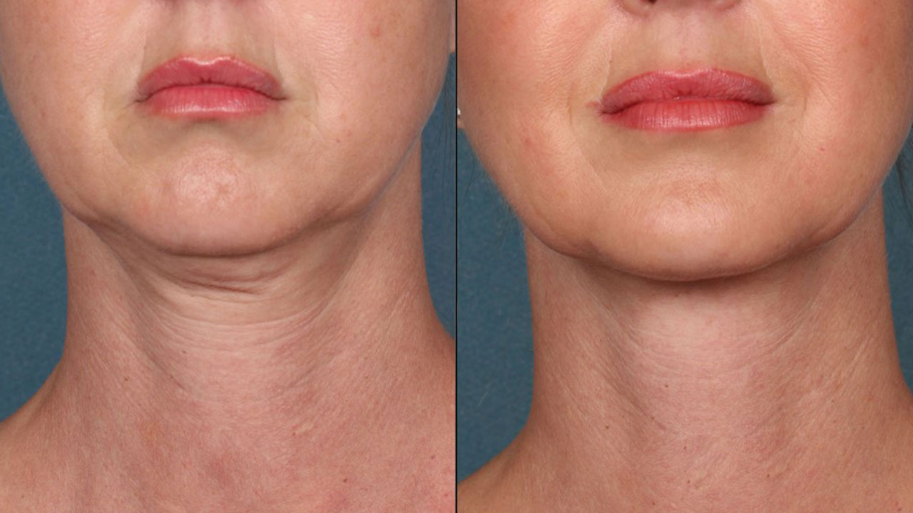 With Dr. Richard Huy's neck lift method, he has helped customers overcome more than 90% of sagging, excess, aging skin.