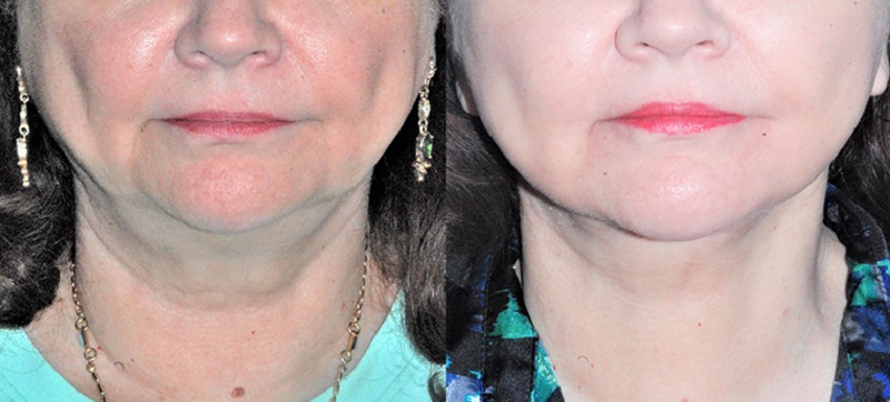 Image after neck lift for a client with signs of sagging, deep wrinkles