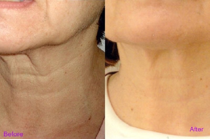 Neck lift is suitable for cases with wrinkled and sagging neck skin
