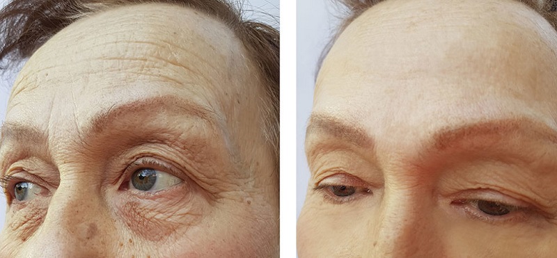 Endoscopic forehead lift is a modern cosmetic technique, bringing optimal results