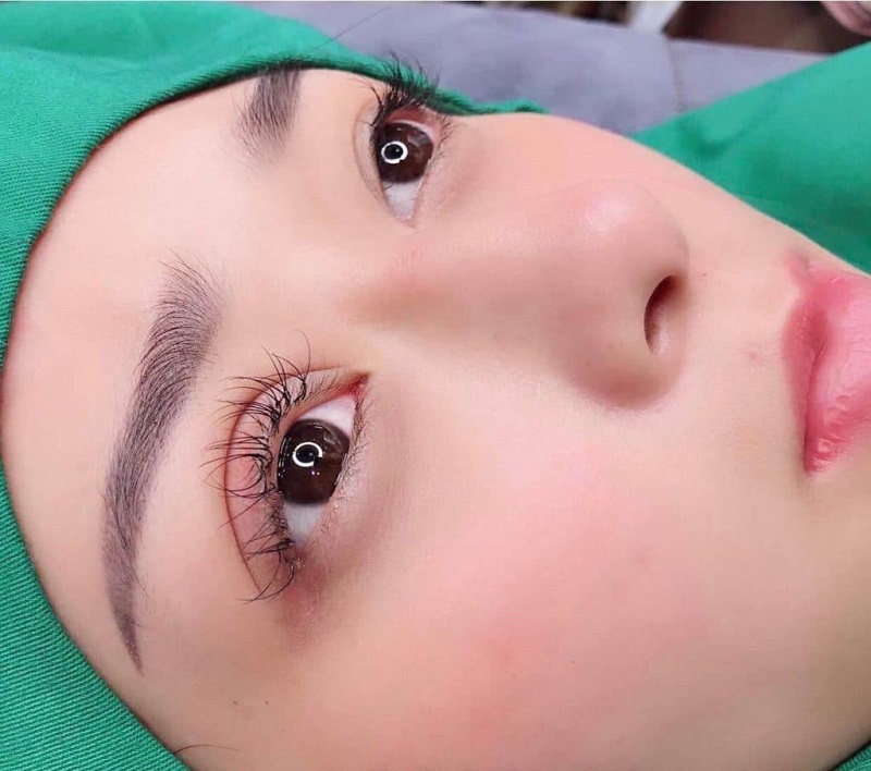 Eyelid surgery is a new method of recreating eyelid folds
