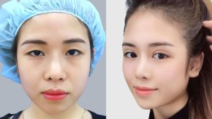 Dr. Richard Huy's Blepharoplasty